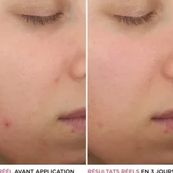 It Cosmetics Bye Bye Breakout                Sérum anti-acné à l'acide salicylique